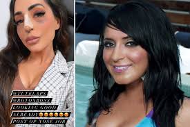 Jersey Shore's Angelina Pivarnick gets a nose job & shares graphic  post-plastic surgery photos of face after divorce