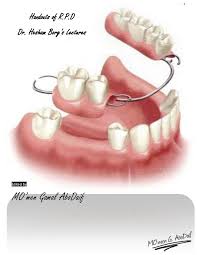 A removable partial denture (rpd) is a denture for a partially edentulous patient who desires to have replacement teeth for functional or aesthetic reasons and who cannot have a bridge (a fixed partial denture) any reason, such as a lack of required teeth to serve as support for a bridge (i.e. Removable Partial Denture Midterm