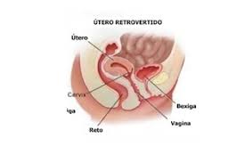 Utero Virado Alguem Tem E Ovario Policistico Utero Invertido O Que Fazer Para Engravidar