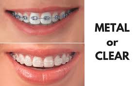 Are Adult Braces Worth It? We Asked 8 People For Their Honest Reviews (See  Photos) | Self