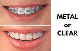 Keeping your teeth flossed is essential for having white teeth. Ask Your Fort Worth Dentist Should I Get Metal Or Clear Braces Archstone Dental Orthodontics Aledo Azle Fort Worth Weatherford Granbury Tx