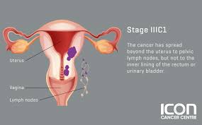 If you started menstruation early or experienced a late menopause, you have a higher risk of uterine cancer. Uterine Cancer Icon Cancer Centre Singapore