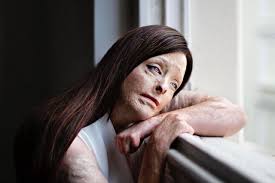 Melanie Grimsley: Portrait of NI mum who survived horrific fire reaches  final of prestigious UK competition