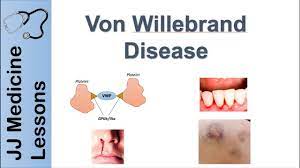 Von Willebrand Disease Pathophysiology Types Symptoms And Treatment Youtube