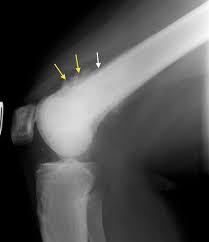 Image result for Osteosarcoma