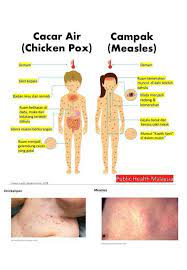 Penyakit cacar air atau dalam istilah medis disebut varicella adalah infeksi yang disebabkan virus varicella zoster. Farmasi Aktif Beza Antara Cacar Air Chicken Pox Dan Facebook