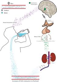 Image result for Hypernatremia