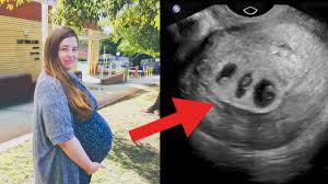 Eva schiwarth, medizinautorin | antje fischer, medizinautorin einfach durchzuführen, risikolos, kostengünstig: 22 Jahrige Ist Schwanger Was Sie Am Ultraschall Sieht Ist Zugleich Schon Und Beangstigend Youtube