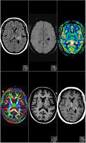 It has become clear that schizophrenia is not just a mental illness, but also a brain disease. Frontiers Brain Tumor Associated Psychosis And Spirituality A Case Report Psychiatry