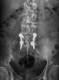 Christian mazel, chirurgien orthopédiste à l'institut mutualiste il y a l'infiltration faite au cabinet du rhumatologue qui consiste à injecter des corticoïdes dans les muscles. Infiltration Par Le Hiatus Sacrococcygien 18 Radiologues A Clermont Ferrand Beaumont Et Saint Amant Tallende Selimed63