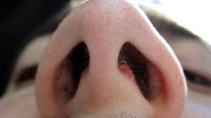 Palatum) er skillevæggen mellem mundhule og næsehule, og ganen danner således loftet i mundhulen. Nese Og Nasofarynkskreft Nhi No