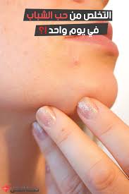 كيفية التخلص من حب الشباب في يوم واحد باستخدام وصفة طبيعية ومضمونة With Images Beauty Care Beauty
