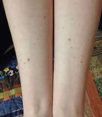 Mole Birthmark Tattoo Cover Up Pisces Constellation Tattoo Done Up To Look Like Freckles My Third Tattoo From Kyrsta Lanniga Star Tattoos Pisces Constellation Tattoo Constellation Tattoos