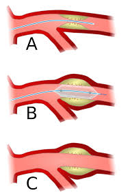 Angioplasty, also known as balloon angioplasty and percutaneous transluminal angioplasty , is a minimally invasive endovascular procedure used to widen narrowed or obstructed arteries or veins, typically to treat arterial atherosclerosis.1 a deflated balloon attached to a catheter is passed over a. Angioplasty Wikipedia