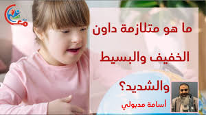 متلازمة داون هي متلازمة وراثية خلقية ناتجة عن خلل في الكروموسومات (جسيمات تحتوي على مادتنا الوراثية). ÙØ§ ÙÙ ÙØªÙØ§Ø²ÙØ© Ø¯Ø§ÙÙ Ø§ÙØ®ÙÙÙ Ù Ø§ÙØ¨Ø³ÙØ· Ù Ø§ÙØ´Ø¯ÙØ¯ ÙØ¹ Ø£Ø³Ø§ÙØ© ÙØ¯Ø¨ÙÙÙ Youtube