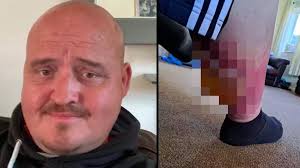 UK news: Man who thought he'd been spiked in pub had actually been bitten  by spider