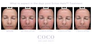 Maybe you would like to learn more about one of these? Halo Hybrid Fractional Resurfacing Laser Coco Skin Laser Health