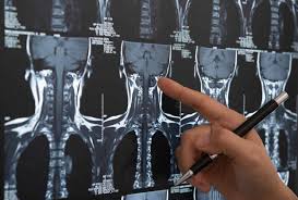 Image result for Spinal Trauma