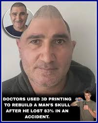 After a devastating accident left a man without 83% of his skull, his  survival seemed impossible. But doctors turned to groundbreaking technology  (3D printing) to create a custom replacement that fit him