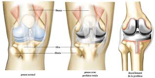 • l'extrémité inférieure du fémur qui a la forme de deux a la fin de l'opération le membre doit être droit. Chirurgie Du Genou Prothese Genou Douleur De Genou