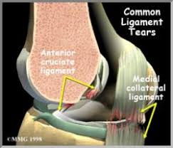 Check out exercises for mcl sprain on top10answers.com. Mcl Tears Mark W Maffet M D