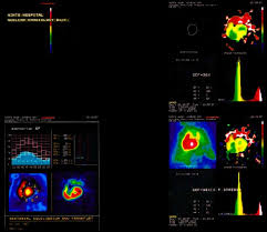 Image result for Nuclear Ventriculogram
