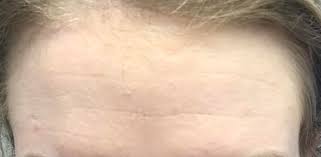 Biossance Squalane Phyto Retinol Serum Reddit Skin Concern I Am 22 Years Old And I Have Very Noticeable Lines In My Forehead How Do I Combat This Skincareaddiction