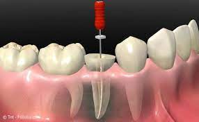 Hat der zahnarzt keine röntgenaufnehme gemacht? Wurzelbehandlung Zahnarzt Leverkusen