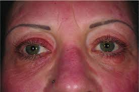 Brain structure in pediatric tourette syndrome. Pathogenese Und Klinik Der Rosazea Als Schlussel Fur Eine Symptomorientierte Therapie Reinholz 2016 Jddg Journal Der Deutschen Dermatologischen Gesellschaft Wiley Online Library