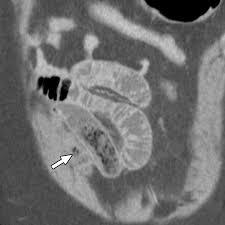 Image result for Bezoar