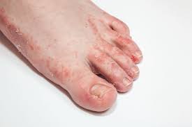 Athlete S Foot Facts Causes Symptoms Genetics Treatment Prevention Factdr