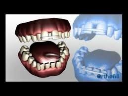 How to close gap in teeth yourself. Orthofill Is The Best Solution To Fix Teeth Gap Dentists Have Developed Orthofill Teeth Gap Bands As A Professional Way To Cl Gap Teeth Fix Teeth Diy Teething