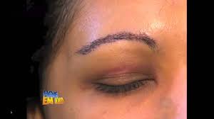 Reportaje en vídeo de un implante capilar, comentado por paciente y cirujano. Implante De Sobrancelhas Implante Capilar Dr Fabricio Ribeiro Programa Hoje Em Dia By Fabricio Ribeiro