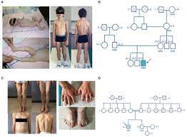 For more information, visit gard. Frontiers Congenital Generalized Lipoatrophy Berardinelli Seip Syndrome Type 1 Description Of Novel Agpat2 Homozygous Variants Showing The Highly Heterogeneous Presentation Of The Disease Endocrinology