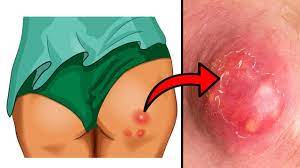 How to Get Rid of Boils on the Bum & Thighs - YouTube