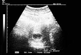 Having your abdomen and 12 weeks can the dating scan tomorrow with baby. 7 Weeks Pregnant Ultrasound Procedure Abnormalities And More