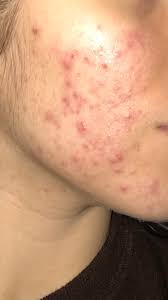 Also you have to use best fungal acne safe moisturizer and best fungal acne safe sun screen. Acne Discussion Could This Be Fungal Acne Experiences With Fungal Acne Skincareaddiction