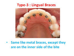 The braces which do not have parent braces must not be selected. 5 Most Available Dental Braces In Barsha