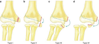 Medial epicondyle fractures also occur in combination with elbow dislocations. Medial Epicondyle Fractures Springerlink