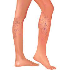 Accueil » archiver par catégorie douleurs aux jambes. Sante Comment Traiter Les Varices Conseils Ufc Que Choisir