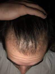 And the idea that thinning hair is simply a symptom of menopause is a myth: I M 20 Starting Losing My Hair At 16 Is It Time To Start Shaving Bald