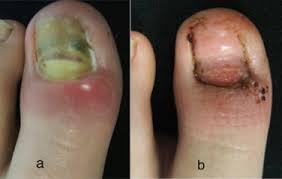 Image result for Paronychia feet