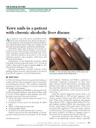 chronic alcoholic liver disease