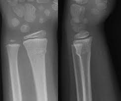The wrist may be tender, slightly swollen, and painful to move. Radiograph Of Torus Fracture Of Distal Radius Anterior Posterior And Download Scientific Diagram
