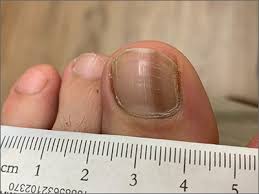 These melanomas can appear anywhere on the body including underneath fingernails and toenails. Dark Toenail Line Mdedge Family Medicine