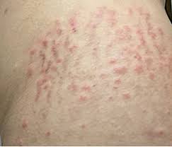 Image result for pruritic urticarial papules and plaques of pregnancy