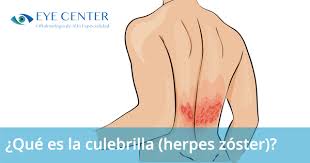La culebrilla no tiene cura, ya que los síntomas, dolor y sarpullido normalmente desaparecen después de unas semanas, sin embargo, existen varios tratamientos para disminuir las molestias y el dolor que esta enfermedad genera. Que Es La Culebrilla Herpes Zoster Eye Center
