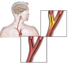 In the neck, the following diagram points out the major landmarks of the neck. Carotid Artery Stenosis Wikipedia