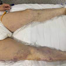 Törende, şehitler ölmez, vatan bölünmez sloganları atıldı. Ahmet Can Topcu Medical Doctor Doctor Of Medicine Dr Siyami Ersek Thoracic And Cardiovascular Surgery Center Istanbul Department Of Cardiovascular Surgery