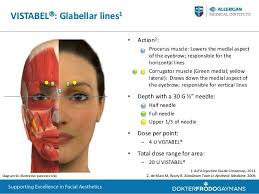 Vistabel Crows Feet Lines1 Depth With A 30 G Needle